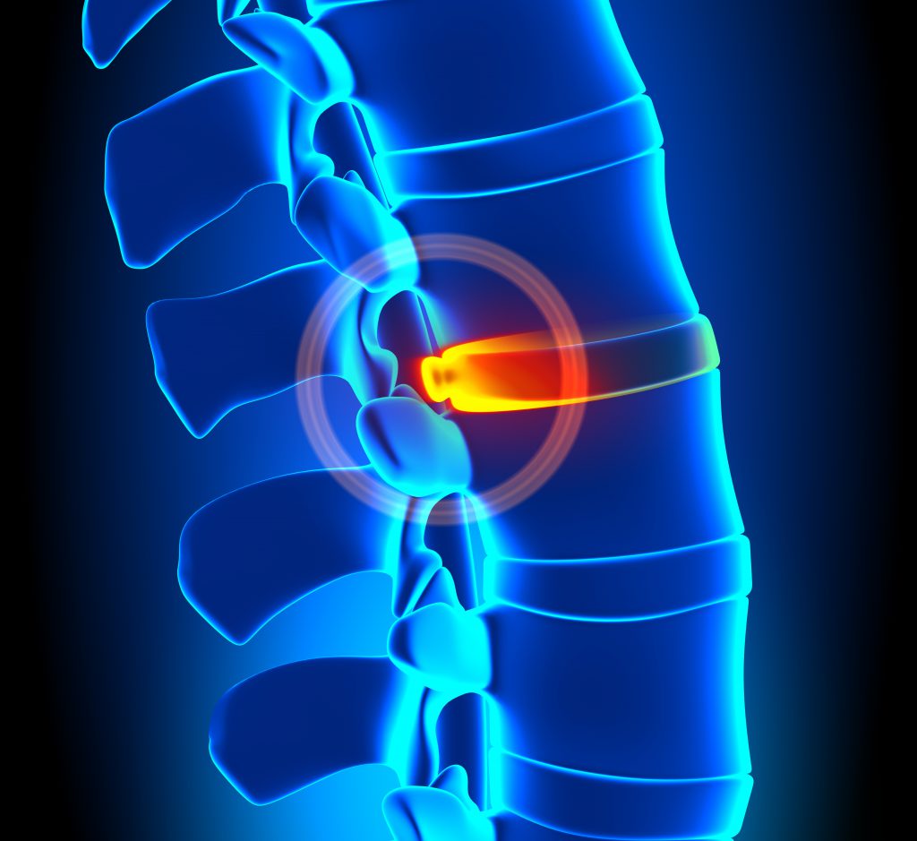 Cervical spine disc bulge