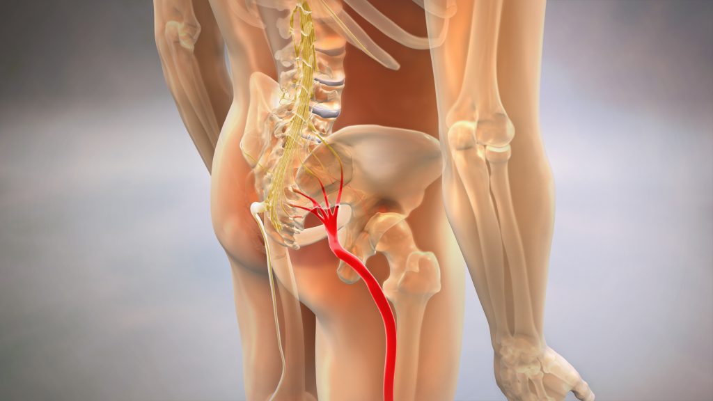 Sciatic (Lumbar) Pain