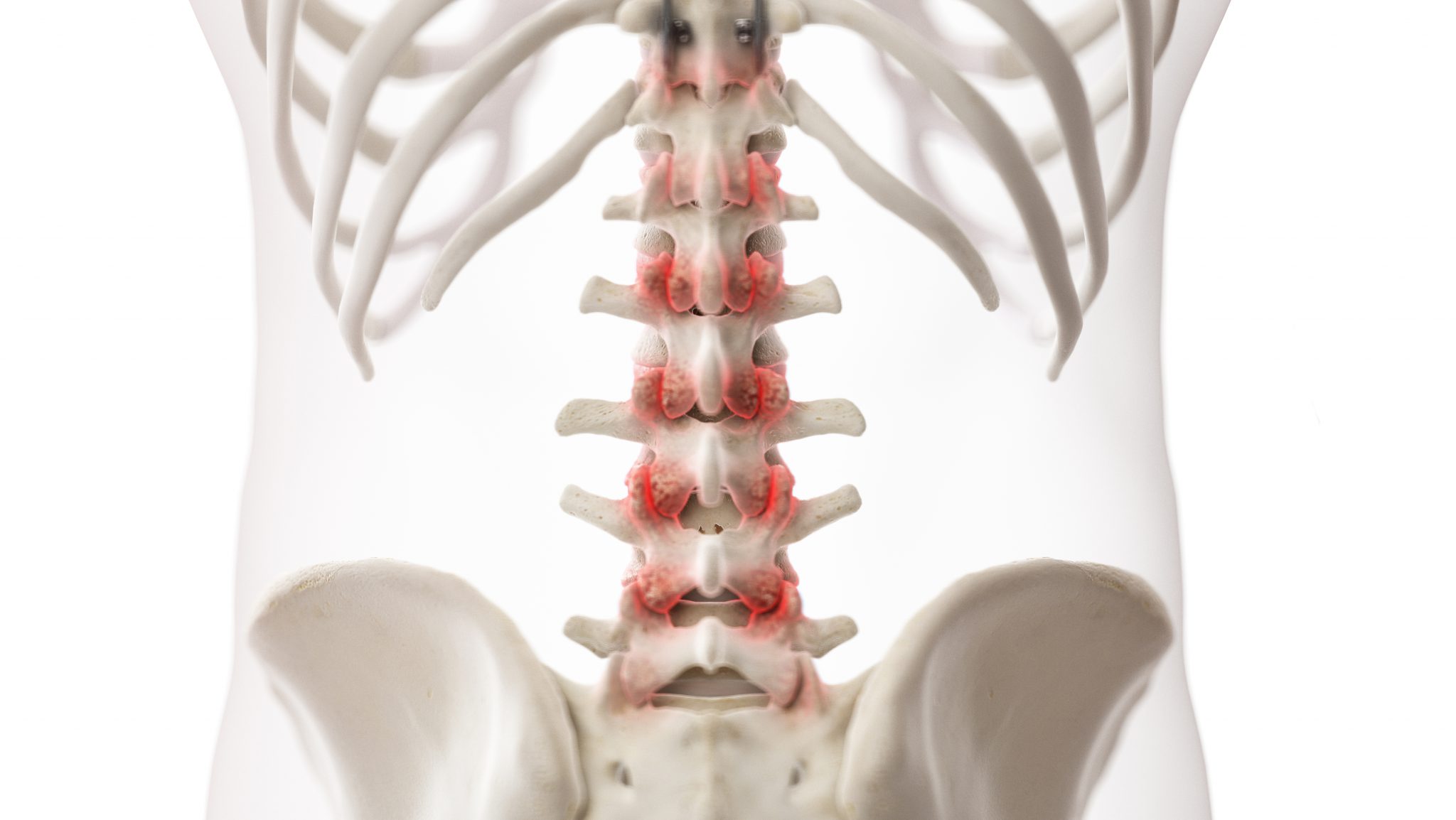 Arthritis Of The Spine Symptoms and Treatments Total Spine and Ortho