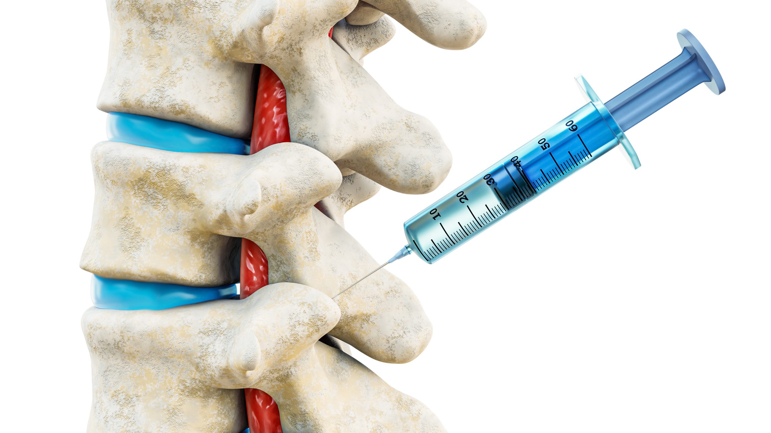 Facet Injections To Relieve Chronic Back Pain Total Spine Ortho