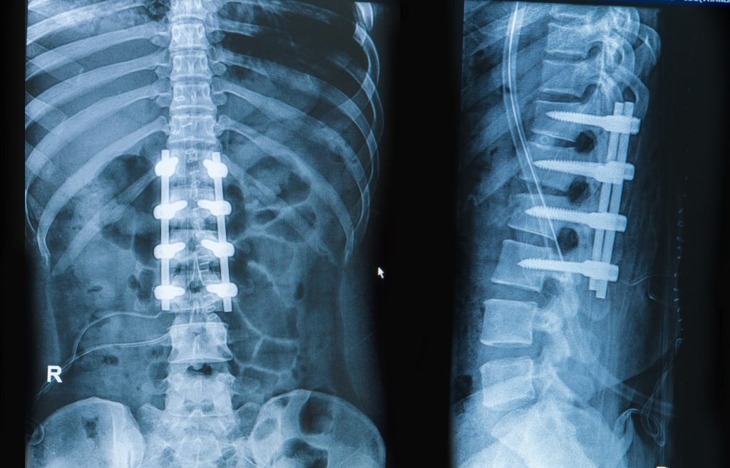 X-ray of a spinal fusion
