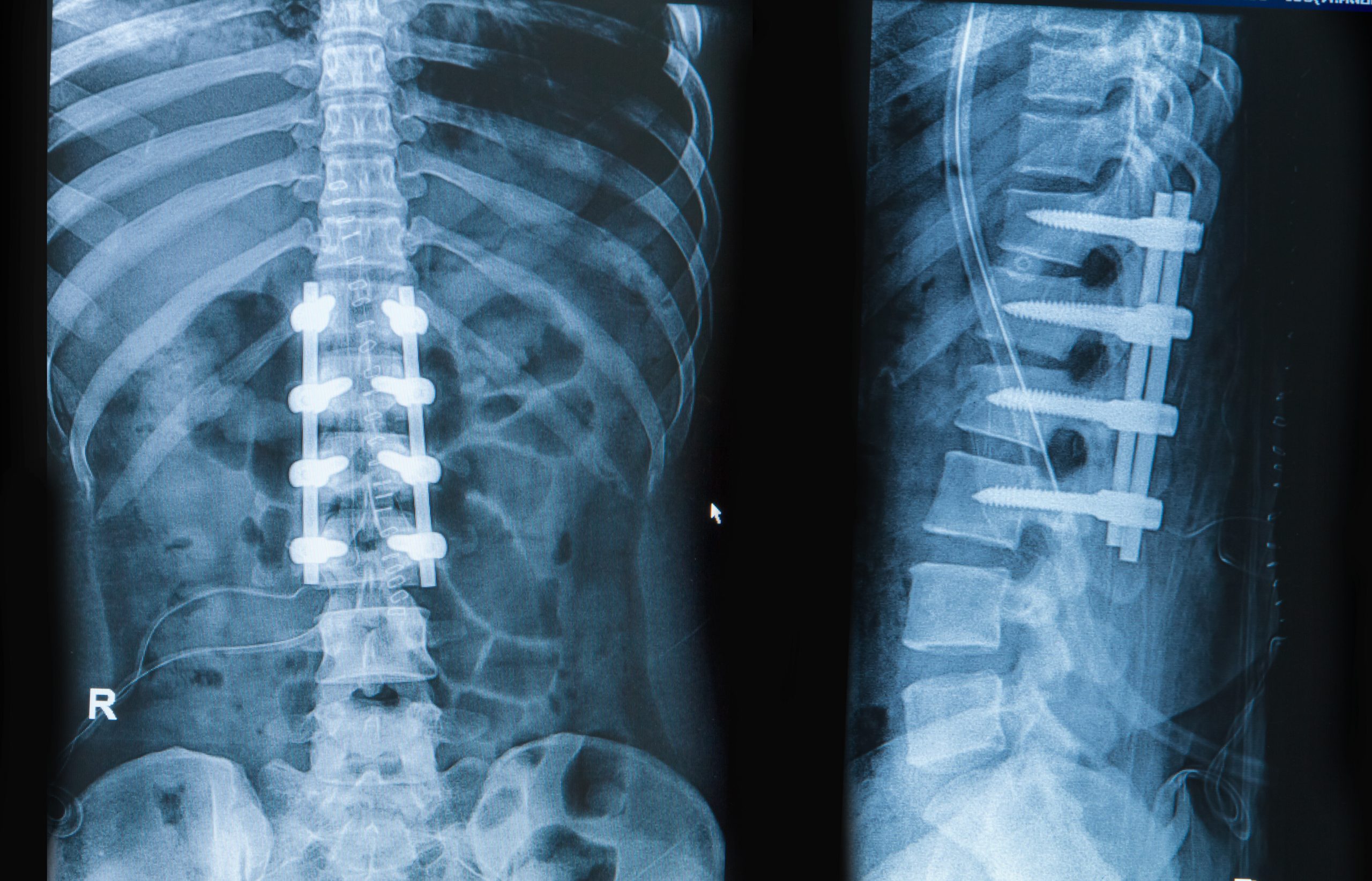 Transforaminal Lumbar Interbody Fusion Tlif Total Spine And Ortho