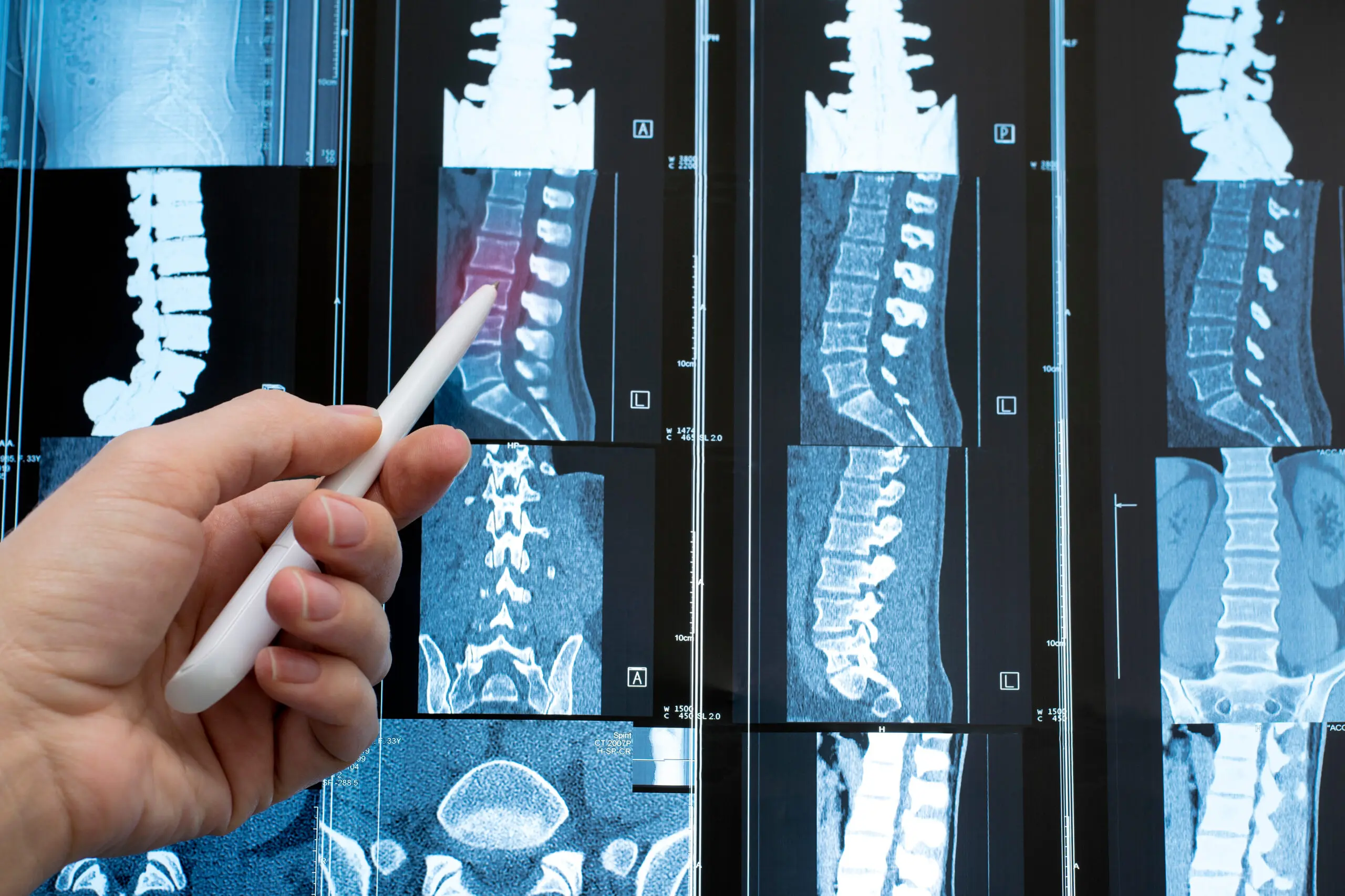 Spinal Stenosis Treatment Options Melbourne