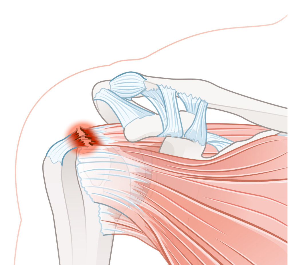 Rotator cuff deals ligament injury