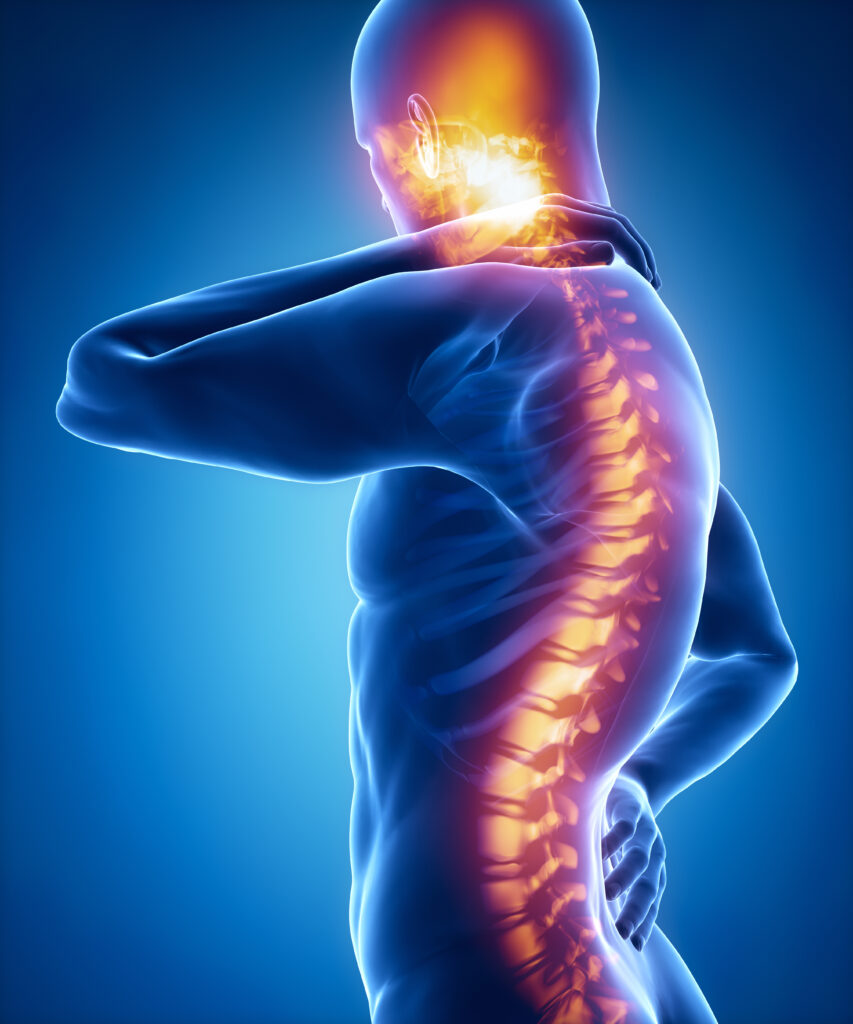 Spine injury pain in sacral and cervical region concept, TLIF surgery