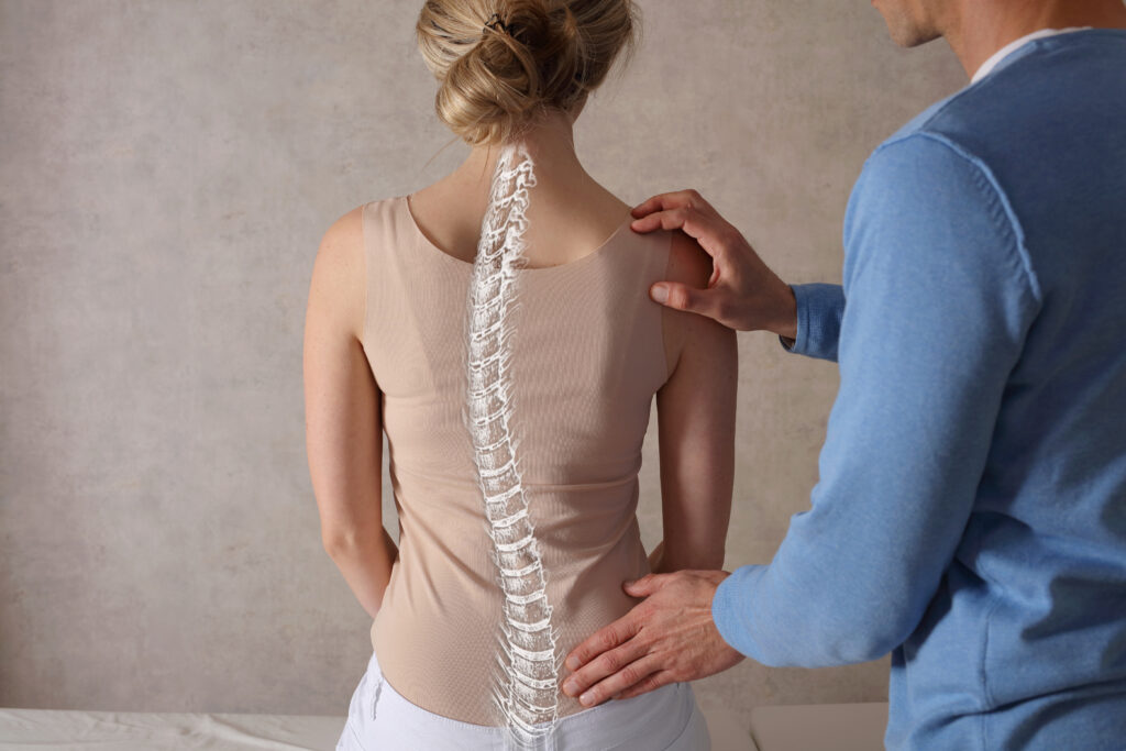 An abnormal curvature of the spine