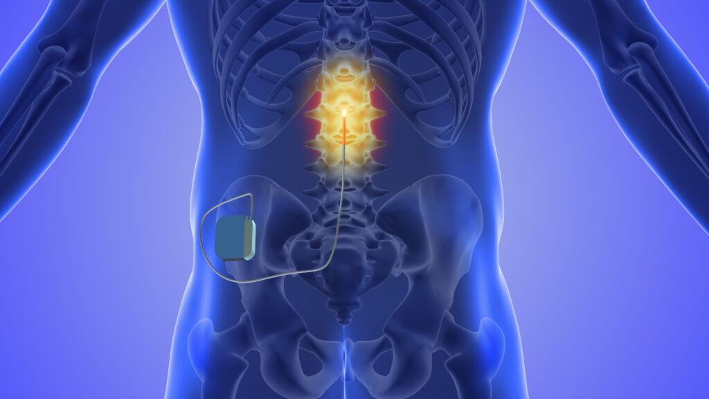 An illustration of one of the common kinds of spinal cord stimulators.