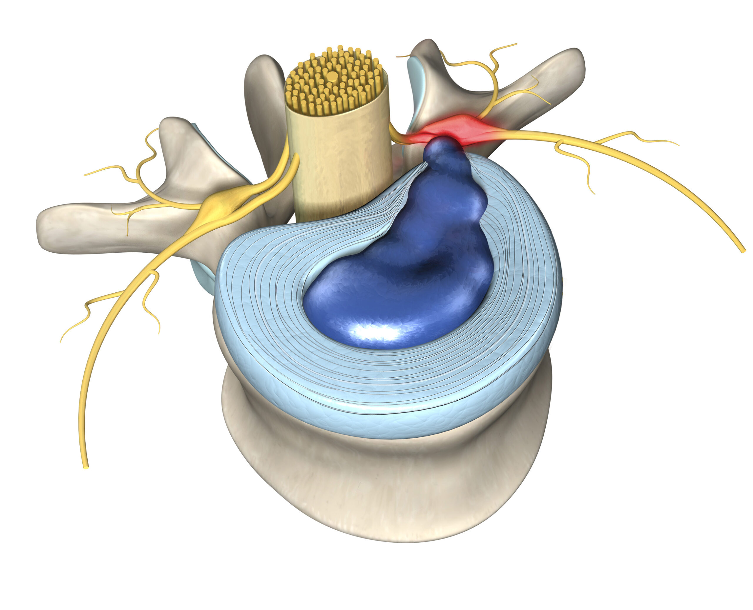 A herniated disc caused by an annular tear leaking onto a nerve root