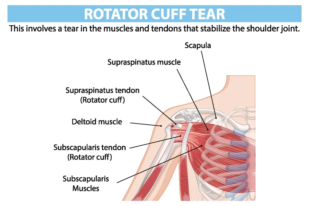 Diagram of a rotator cuff tear in the shoulder