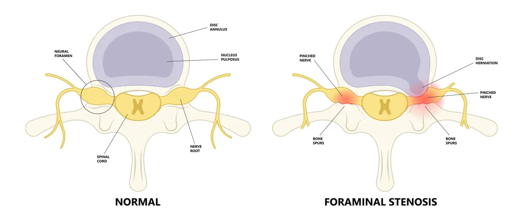 Diagram comparing a normal vertebra with foraminal stenosis