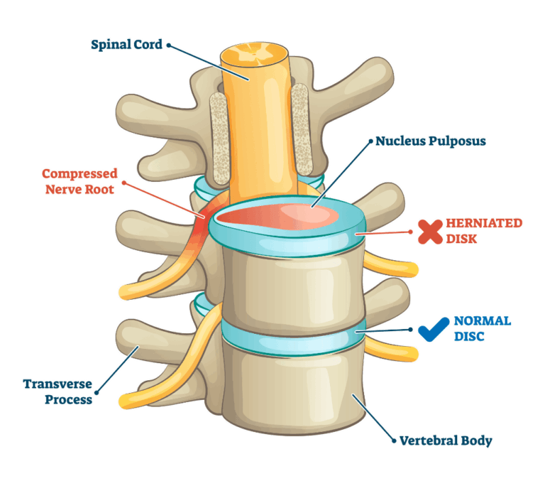 A diagram displaying a human spine with a herniated disc and a normal disc for comparison.
