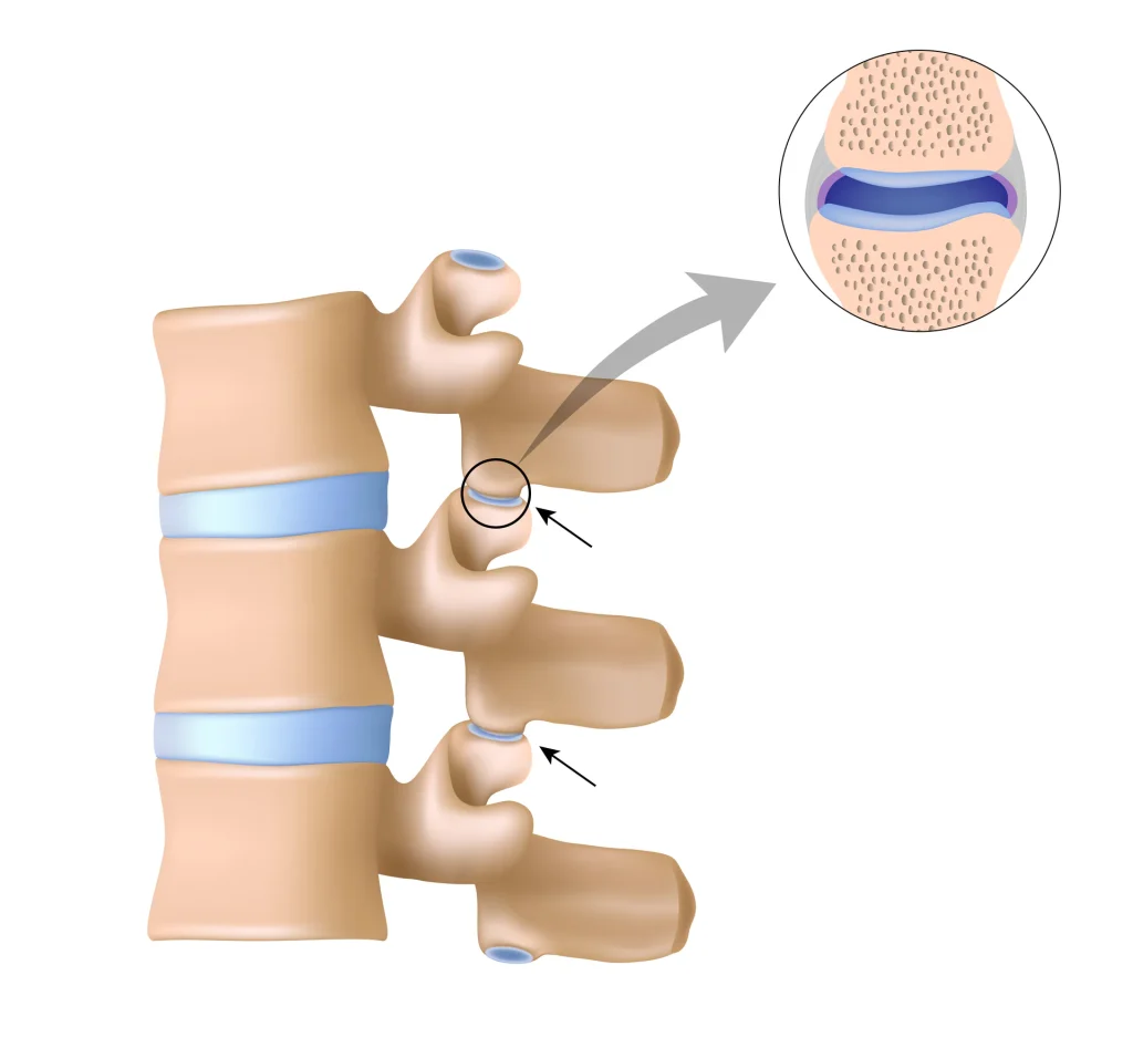 Illustration of the spinal facet joints with a close-up of the joint