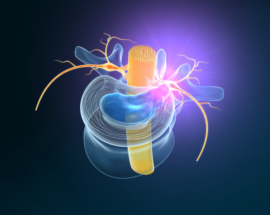A Herniated disc pinching a nerve, medical illustration