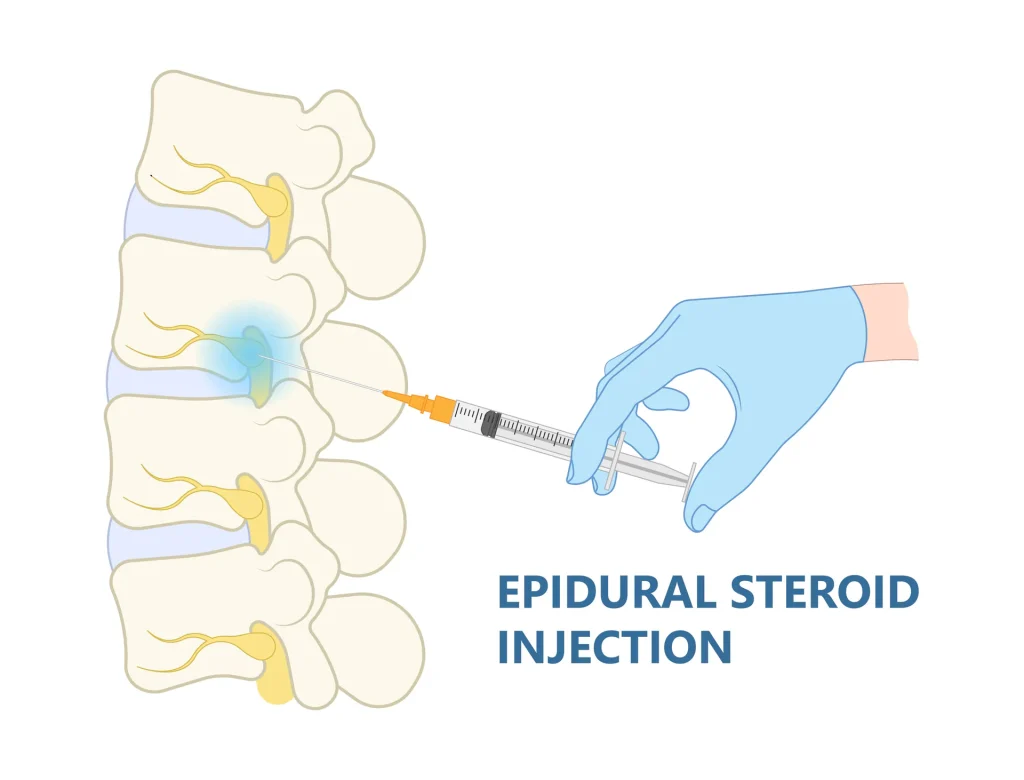 Illustration of an epidural steroid injection into the lumbar spine