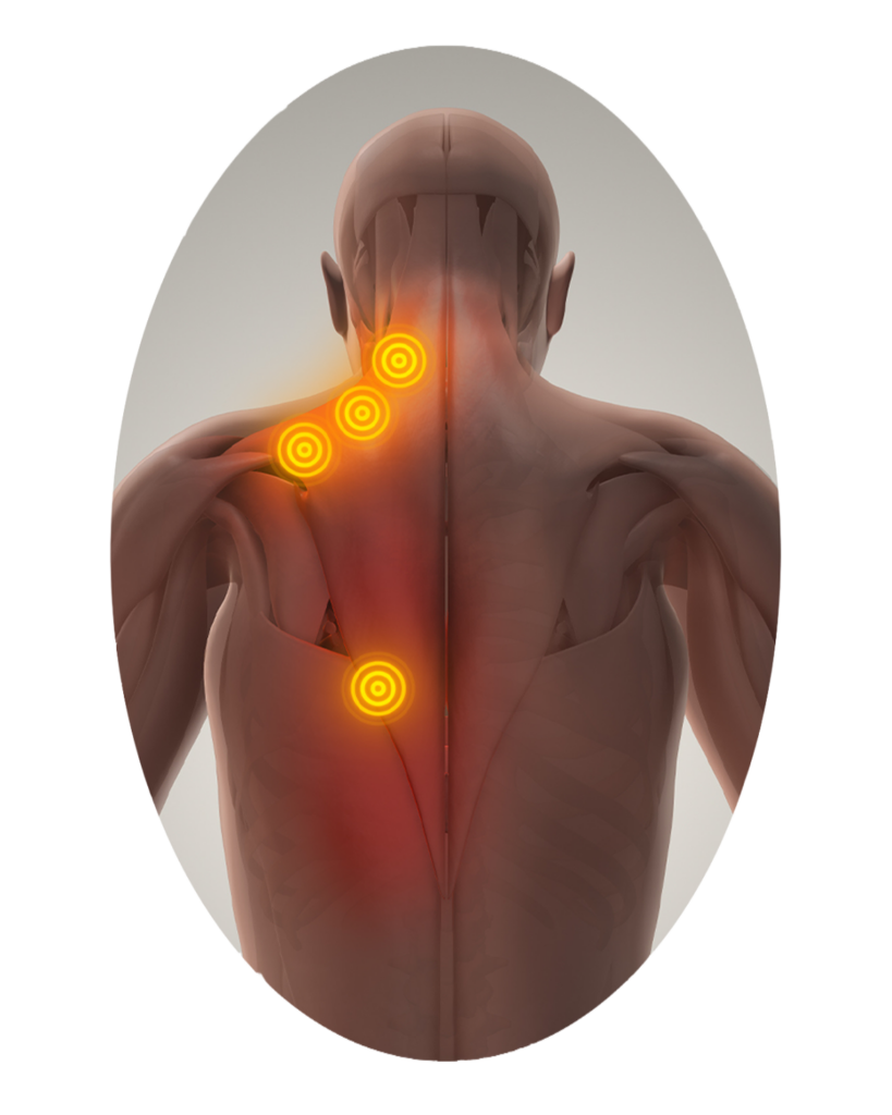 Trigger points highlighted on a person about to receive trigger point injections