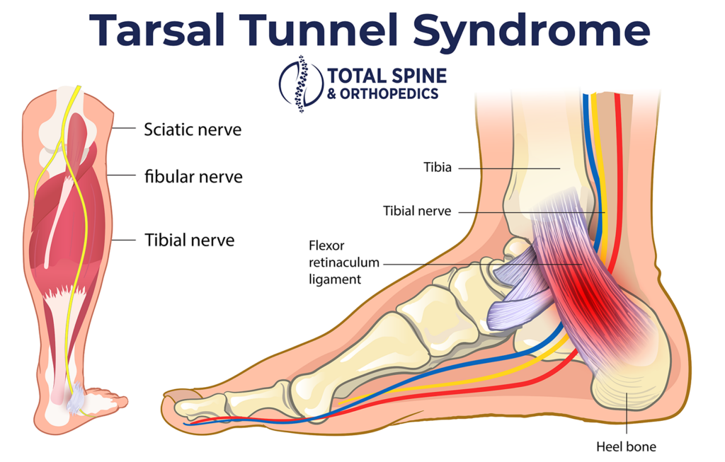 A diagram of a tarsal tunnel syndrome and minimally invasive treatment options