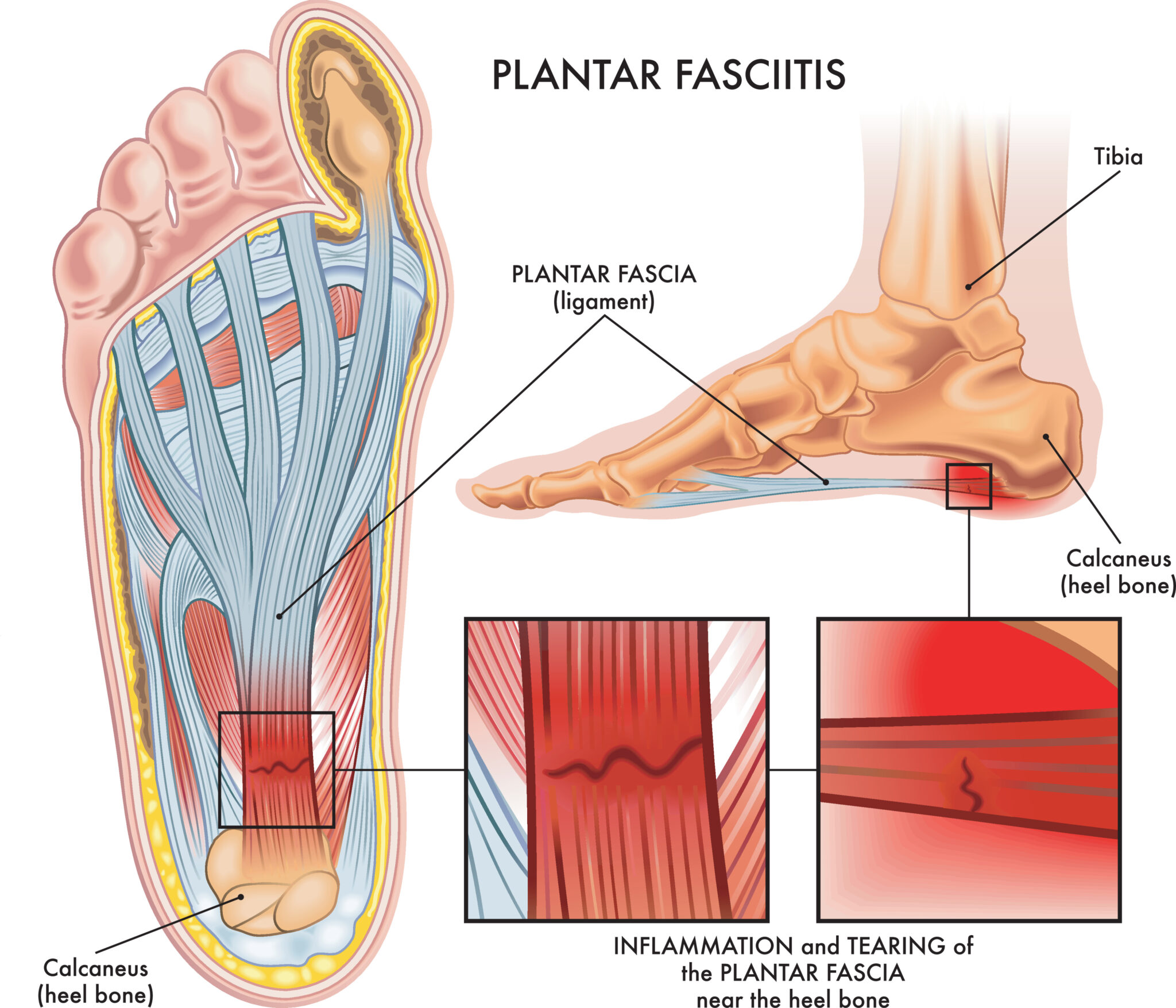 endoscopic-plantar-fascia-release-total-spine-orthopedics