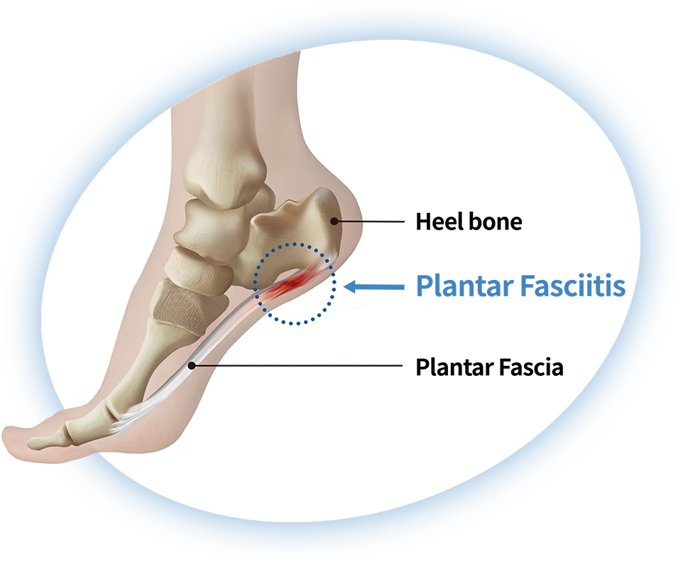 Diagram of plantar fasciitis at the heel bone and plantar fascia