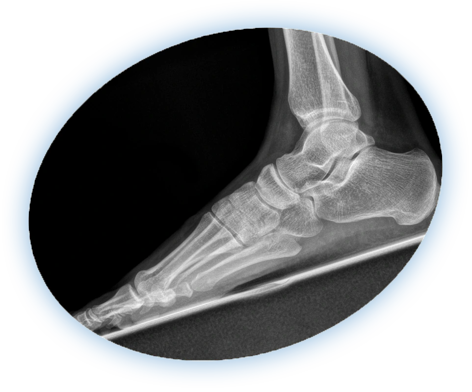 Side-view X-ray of the foot and ankle bones