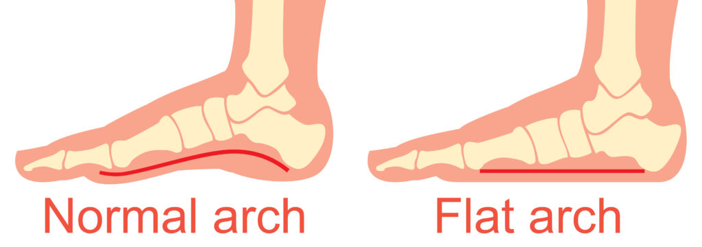 human anatomy - flat and normal arch vector illustration