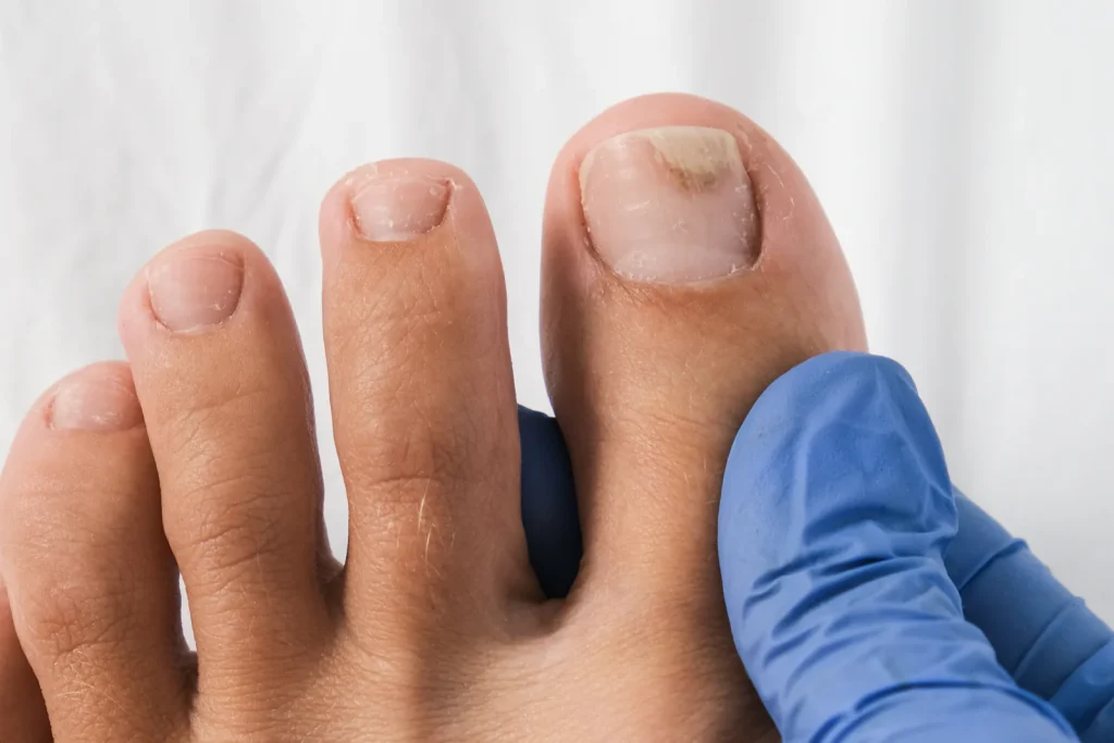 Podiatrist examining a patient's foot with toenail fungus (onychomycosis)